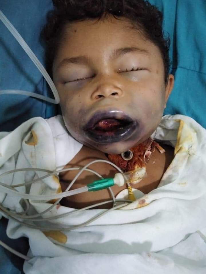 شاهد كيف أصبح طفل يمني لدغته أفعى أثناء نومه .. صورة