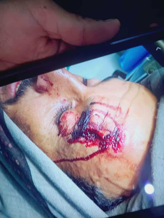 شاهد صورة لمعلم في الضالع مضرجاً بالدماء بعد الاعتداء عليه 
