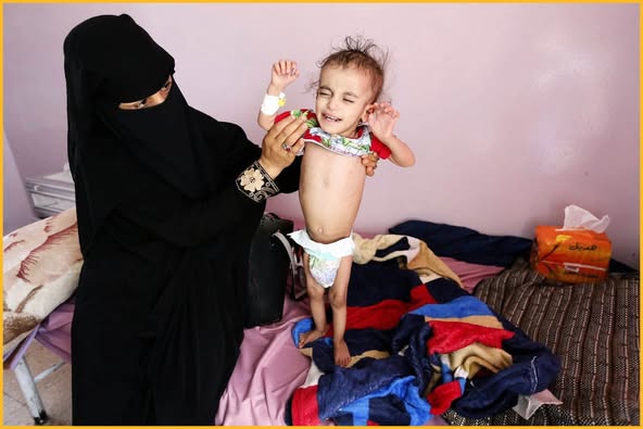 اليمن يشهد ثالث أكبر أزمة غذاء في العالم حسب منظمات إنسانية