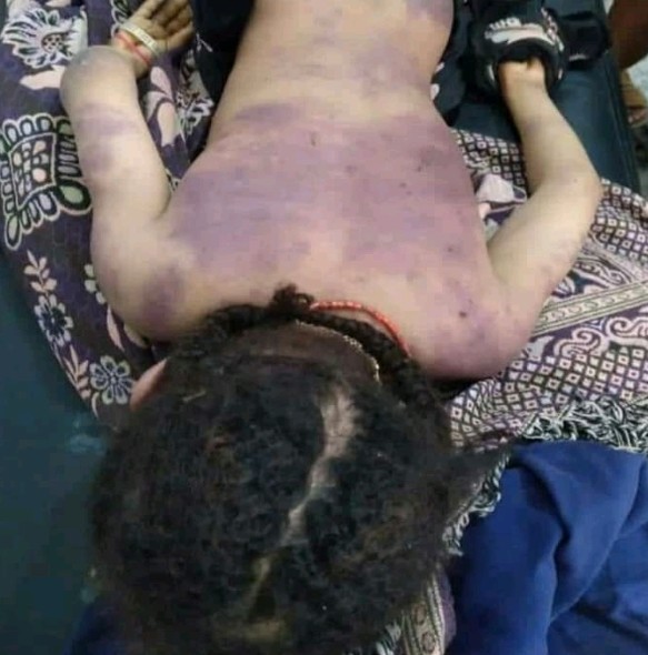 جريمة تهز اليمن .. وفاة طفلة بعد تعرضها للضرب المبرح من قبل والدتها .. صورة