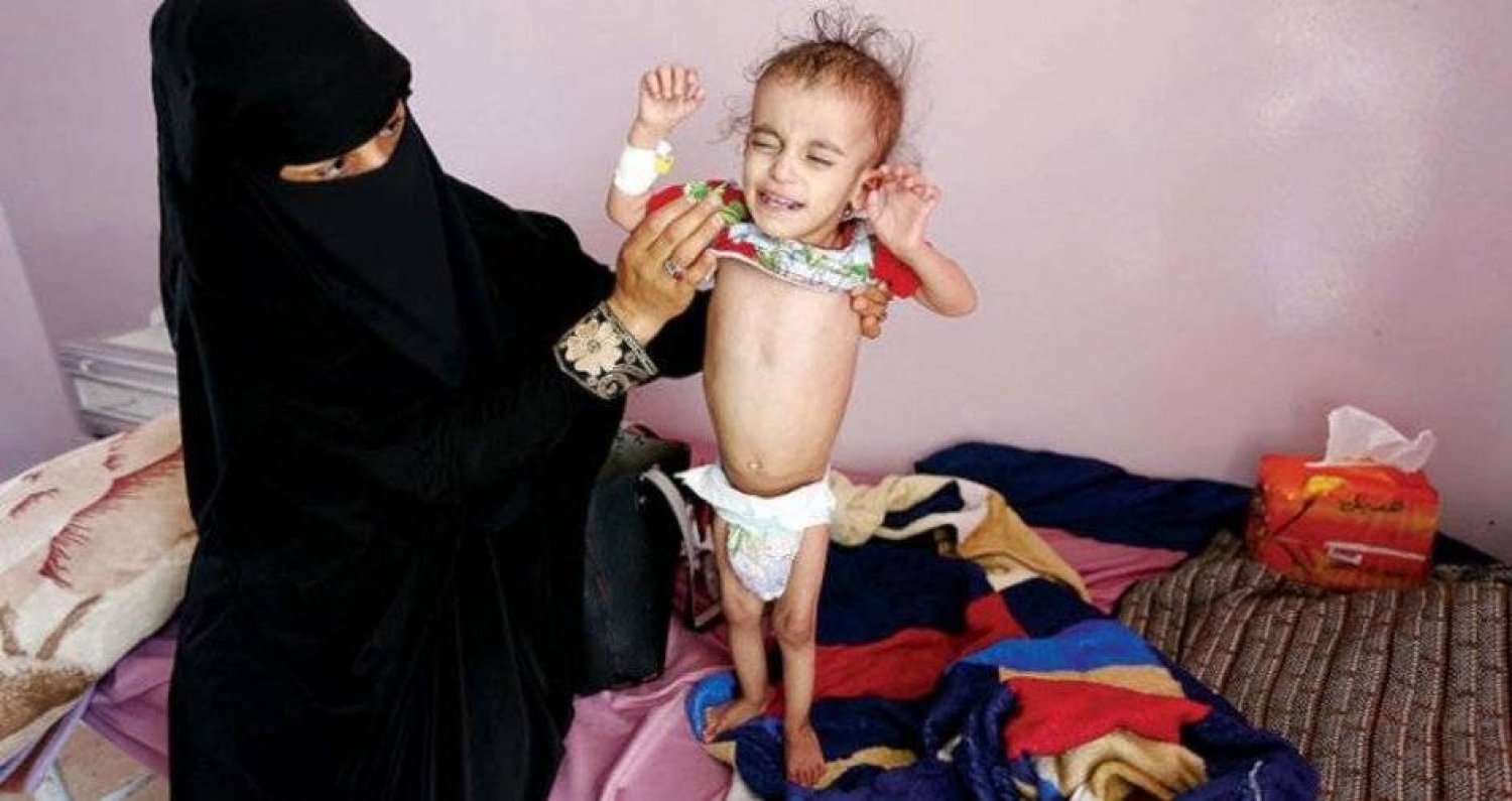 مصادر طبية: ألفا يمني ماتوا بالملاريا خلال شهرين